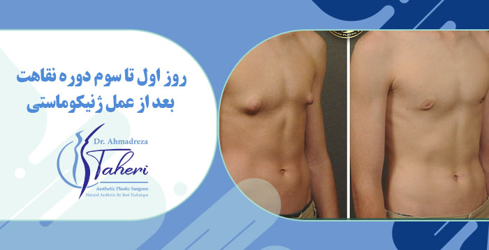 مدت زمان دوره نقاهت عمل ژنیکوماستی چقدر است؟