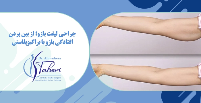 جراحی لیفت بازو؛ از بین بردن افتادگی بازو با براکیوپلاستی