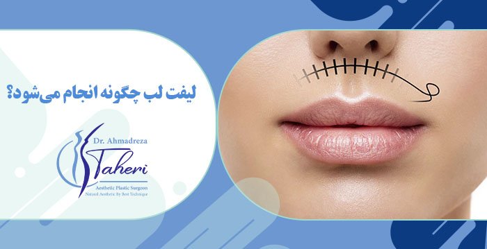 بهترین روش‌های لیفت لب با ماندگاری بالا