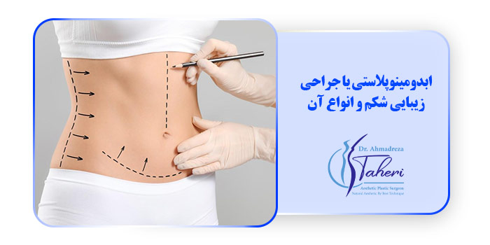 ابدومینوپلاستی یا جراحی زیبایی شکم و انواع آن