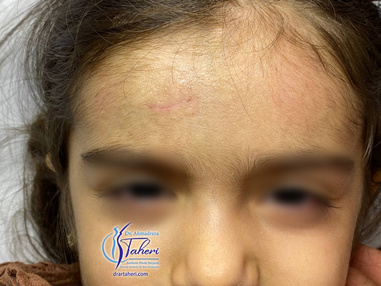 بعد — جراحی کلوئید