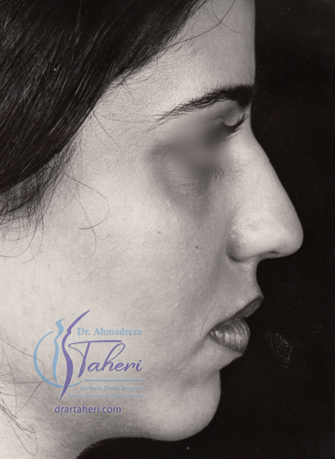 قبل — رینوپلاستی(جراحی بینی)
