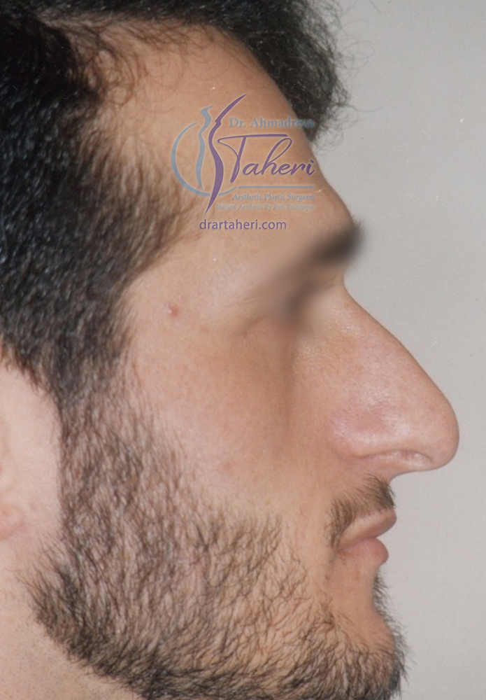 قبل — رینوپلاستی(جراحی بینی)