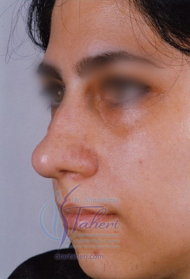 قبل — رینوپلاستی(جراحی بینی)