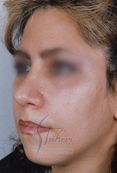 بعد — رینوپلاستی(جراحی بینی)