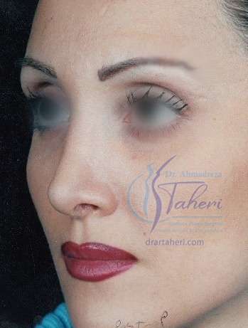 بعد — رینوپلاستی(جراحی بینی)