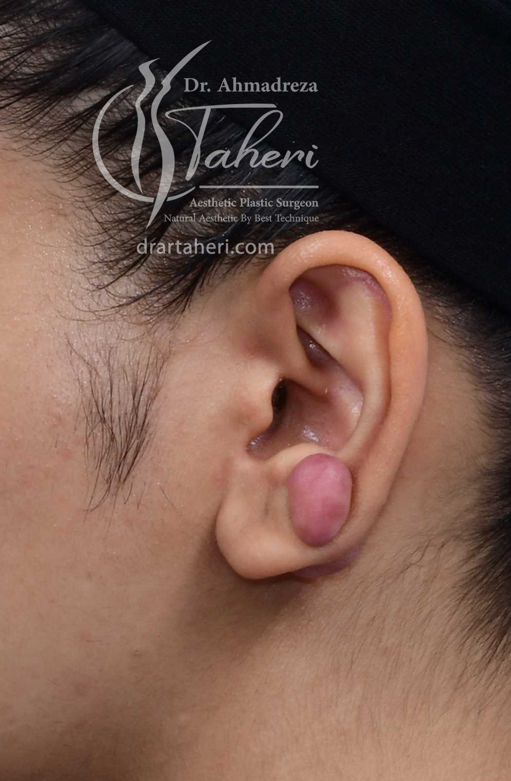 قبل — جراحی کلوئید